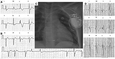 Case report: Challenges and implications of conduction system pacing in pediatrics: Case series